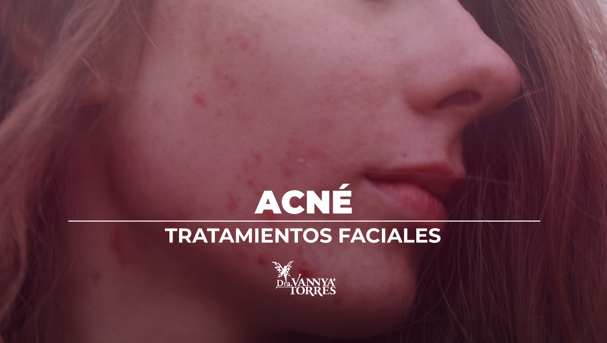 Tratamiento del acné con mesoterapia facial en la CdMx, Miguel Hidalgo, Escandón, Lomas de Chapultepec. Dra Vannya E Torres G. 