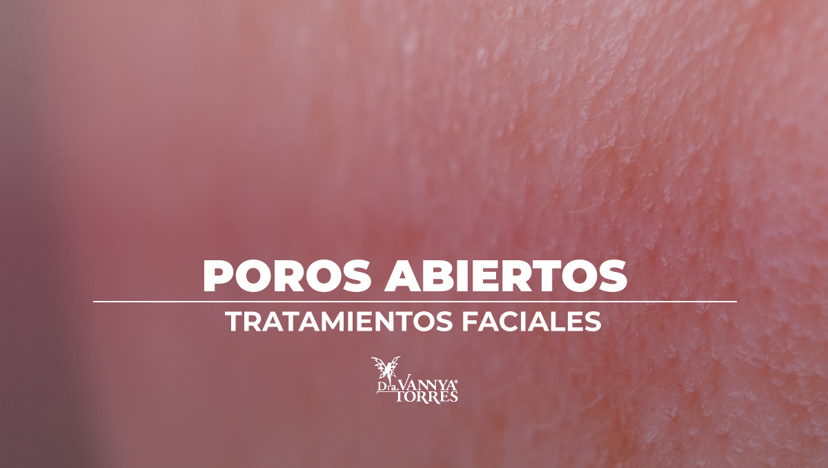 Tratamiento de poros abiertos con mesoterapia facial y corporal en la CdMx, Miguel Hidalgo, Escandón, Lomas de Chapultepec. Dra Vannya E Torres G. 
